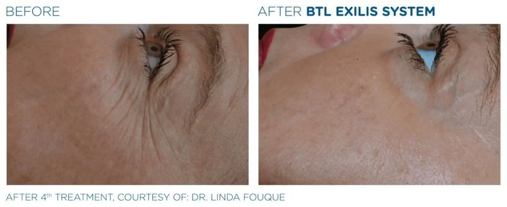 Traitement Exilis Ultra 360 pour la réduction des rides