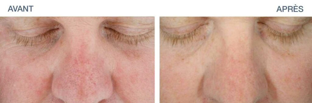 Traitement Hydrafacial Paris 16 - Avant après hydrafacial résultat tâches solaires